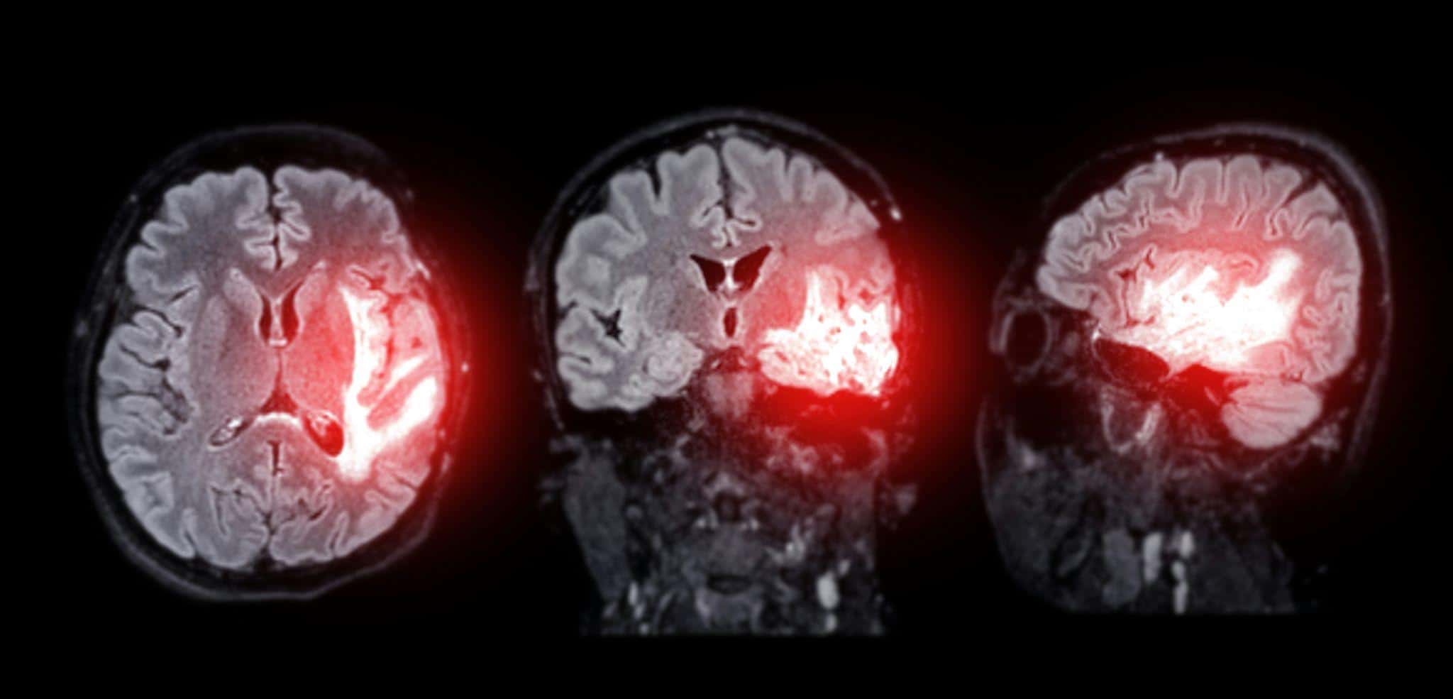 Kavin Mistry discusses early signs of dementia
